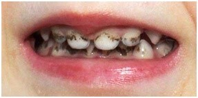 Зубной налет у детей